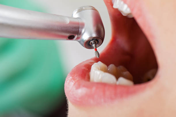 Best Emergency Wisdom Teeth Removal in Whitney, TX